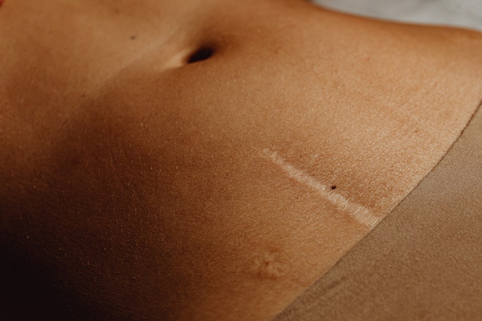O objetivo da mini abdominoplastia é eliminar a flacidez na região inferior do abdômen, corrigir o excesso de pele e dar à barriga uma aparência mais chapada