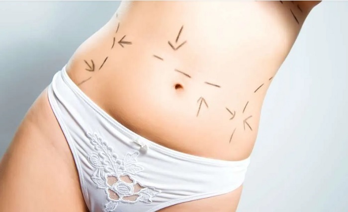 o procedimento da abdominoplastia pode ser aplicado em diferentes casos