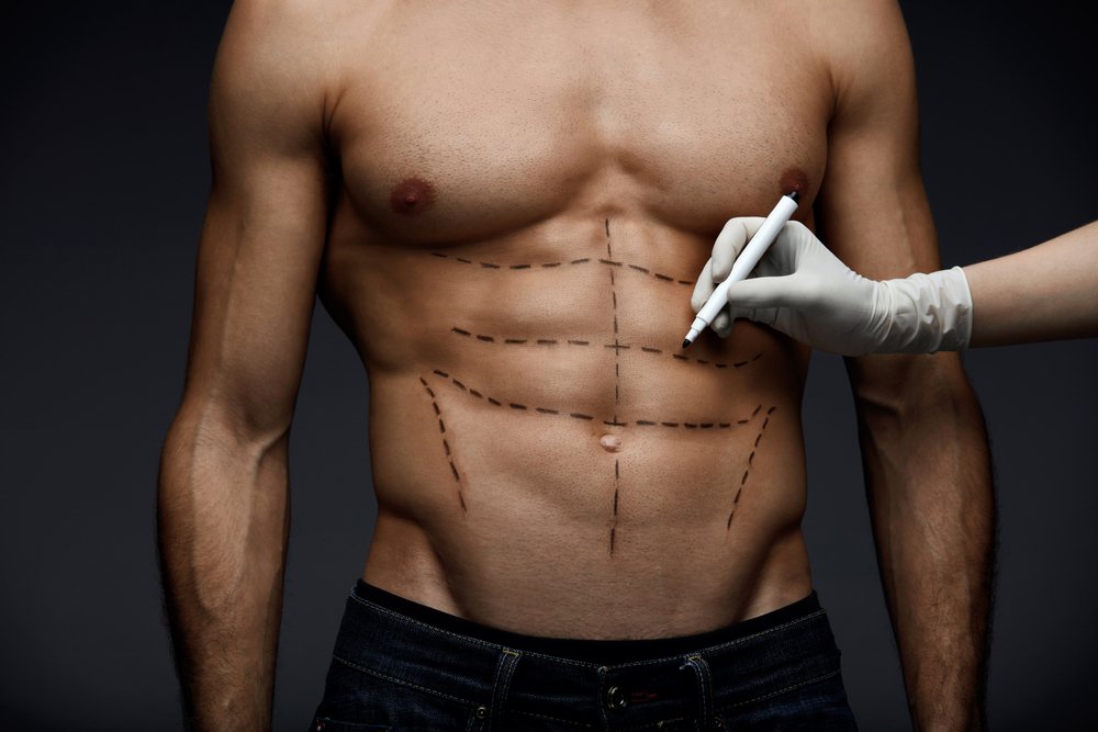 Homem musculoso com marcações cirúrgicas para Lipo HD no abdômen, delineando a definição muscular.