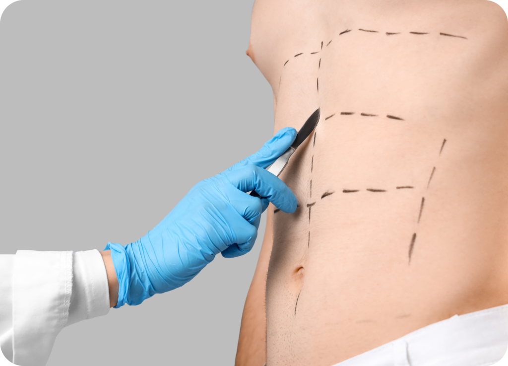 A imagem mostra o tronco de um homem sem camisa, voltado para a esquerda e em um fundo cinza claro. A lateral de um torso masculino é visível, com a mão de um cirurgião em primeiro plano. O cirurgião veste uma luva azul e segura um bisturi prateado. A ponta do bisturi toca o abdômen do homem. O abdômen está marcado com linhas pretas tracejadas que indicam as incisões e o contorno da área a ser operada, sugerindo a preparação para um procedimento de abdominoplastia (cirurgia plástica no abdômen).