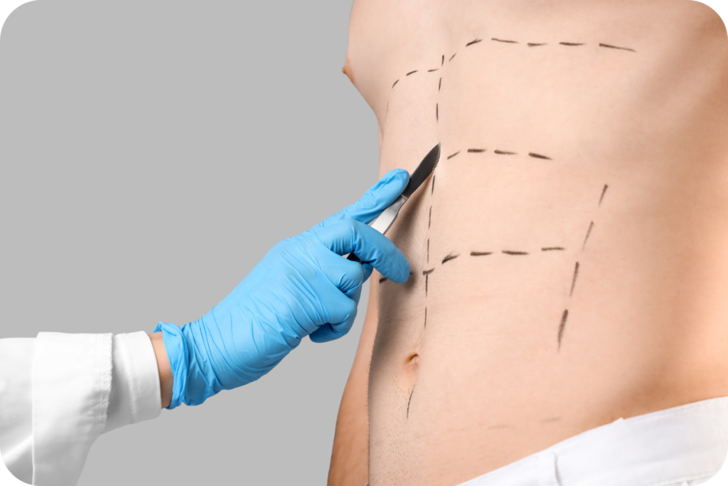 Close-up de um tronco masculino nu onde linhas pontilhadas pretas marcam a região abdominal para um procedimento cirúrgico, como a abdominoplastia. Uma mão usando luva cirúrgica azul segura um bisturi sobre a pele marcada, simulando o início da incisão.